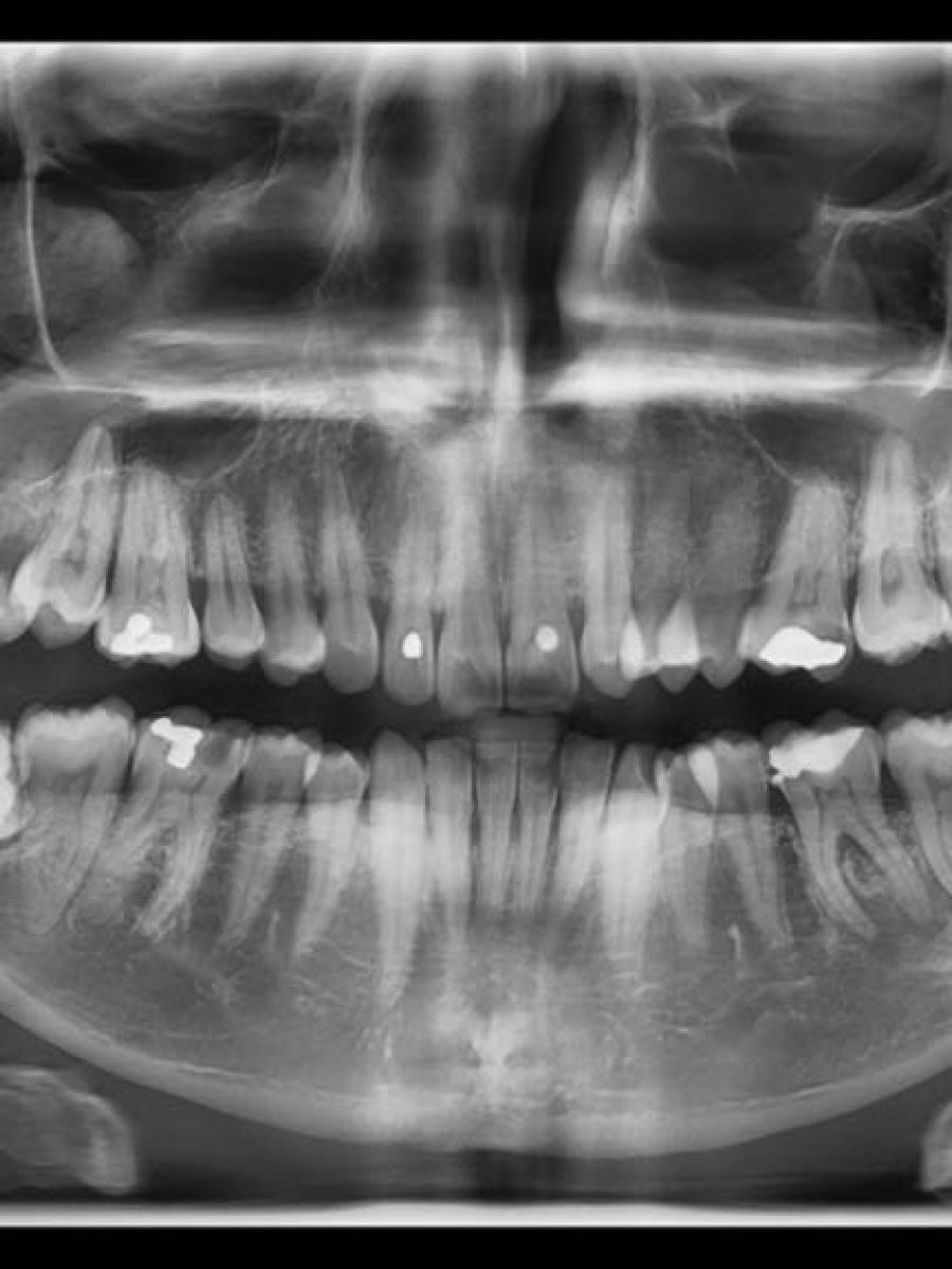 Radiorafía dental